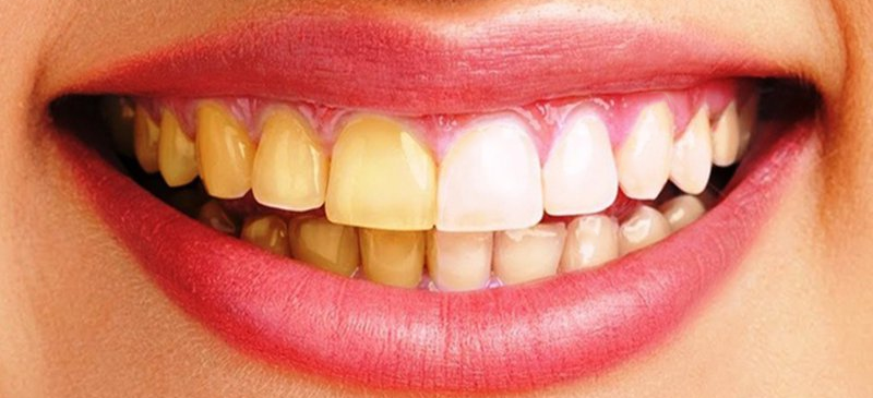 Những Cách làm Trắng Răng Tự Nhiên